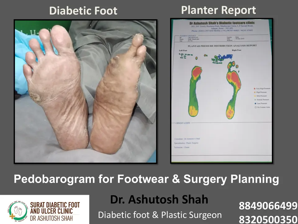 Diabetic Foot  PPT 3 checked by sir.pptx-16.webp